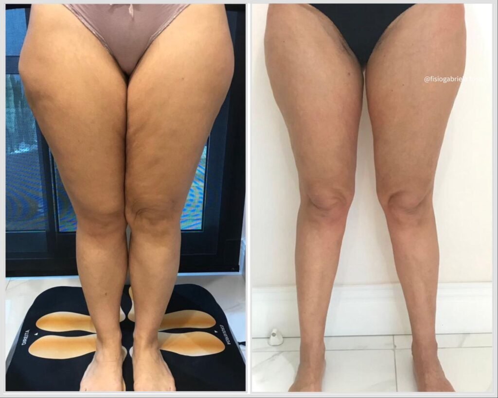 Terapia linfática